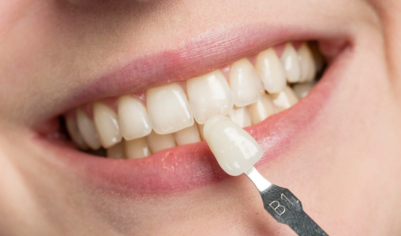 Veneer cost comparison chart for Turkey dental treatment